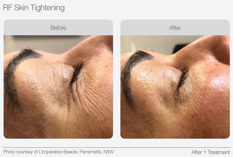 RF Skin Tightening Before & After 03