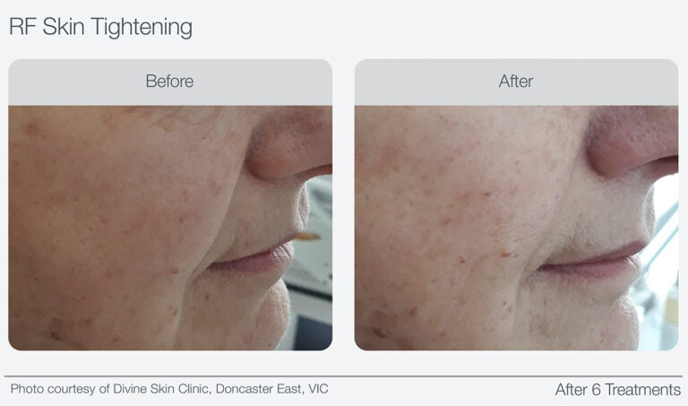 RF Skin Tightening Before & After 04