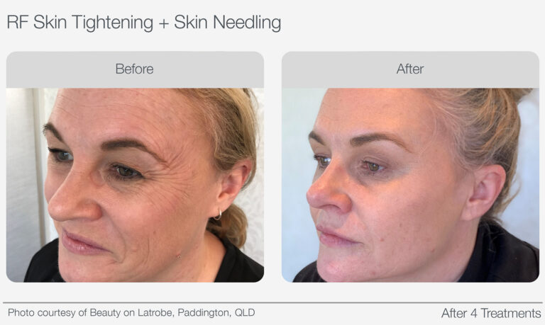 RF Skin Tightening Before & After 06